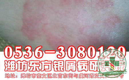 银屑病患者怎样预防复发？
