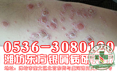 银屑病预防复发的八项注意要点