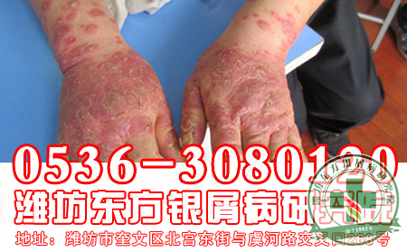 产后女性银屑病如何调养身体？