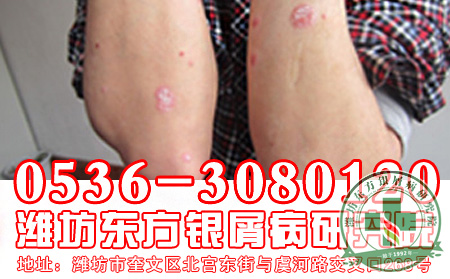 济南银屑病患者—西医是怎么治疗银屑病的？