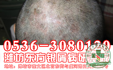 简述：西医治疗银屑病的几大弊端