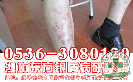 医生告诉你坚定银屑病 的希望