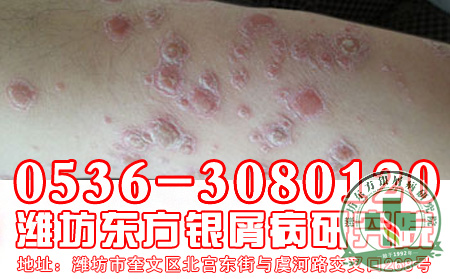 医生讲述：银屑病是角化障碍性皮肤病吗？