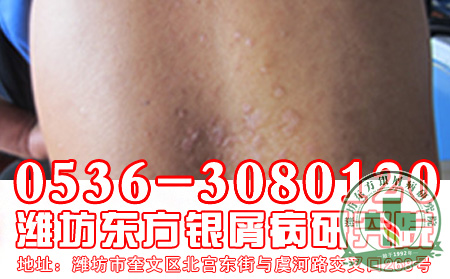 如何准确治疗银屑病？