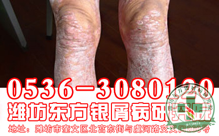 当今治疗银屑病 可以的方法是什么？