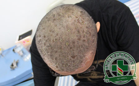 治疗头部银屑病的其他方 