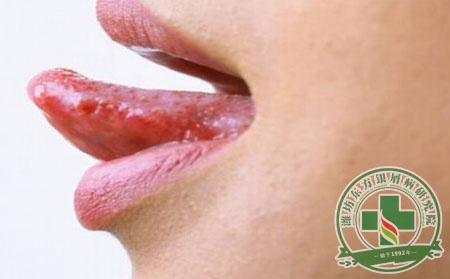 银屑病患者怎么清火？