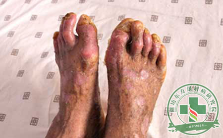 银屑病症状诊断的依据与方法
