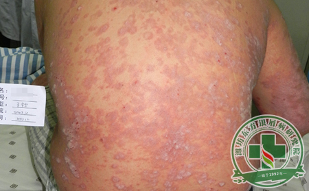 银屑病患者每日健康手册介绍