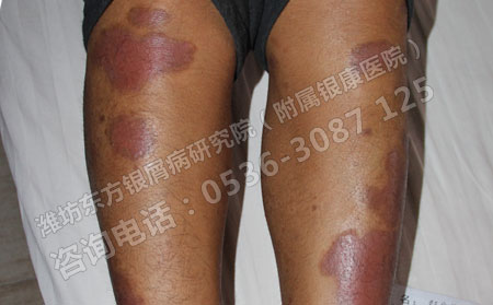 济南银屑病患者冬季如何饮食可以