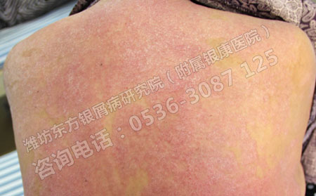 银屑病患者病情为什么会越来越严重