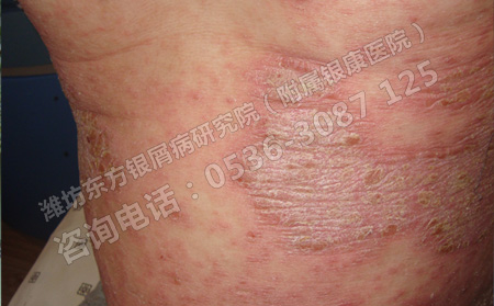 治疗牛皮癣哪些药物要避免