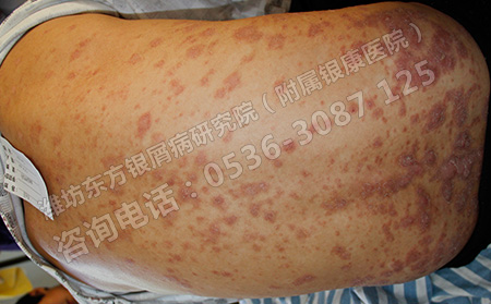 减少复发的牛皮癣预防保健方法