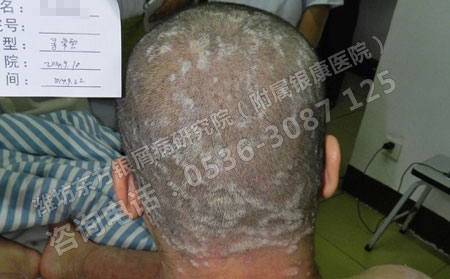 头部牛皮癣患者治疗时需要注意的问题