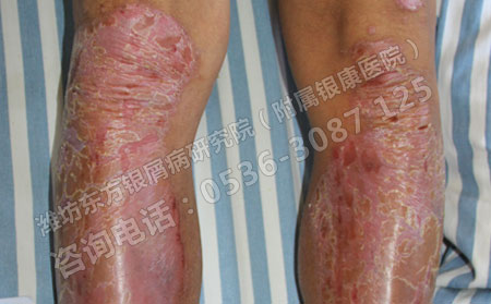 济南银屑病患者如何进行心理治疗