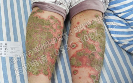 如何借助食物恢复牛皮癣患者健康