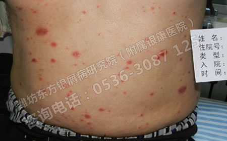 牛皮癣,预防牛皮癣,预防牛皮癣复发