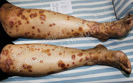 济南银屑病患者吃什么类型的食物可以