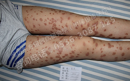 诱发银屑病出现的一些原因介绍