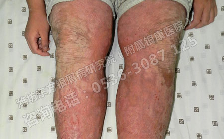 FDA批准银屑病新药ixekizumab