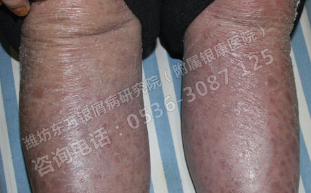 银屑病对健康的危害大不大