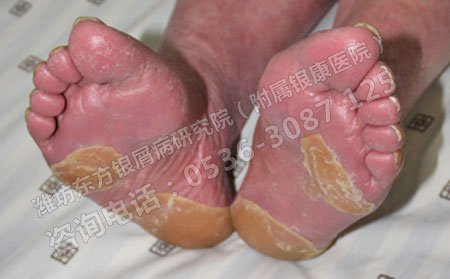 银屑病初期要注意哪些护理措施