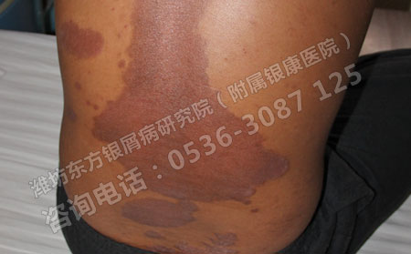 对付牛皮癣反复纠缠哪些误区需要警惕