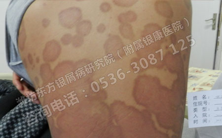 银屑病患者在生活中需要注意什么
