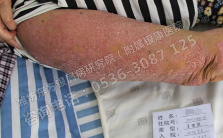 简单讲述银屑病患者的护理方法