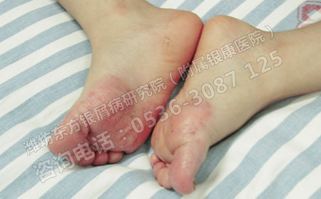用食疗可以治可以牛皮癣吗患者怎么吃出健康呢