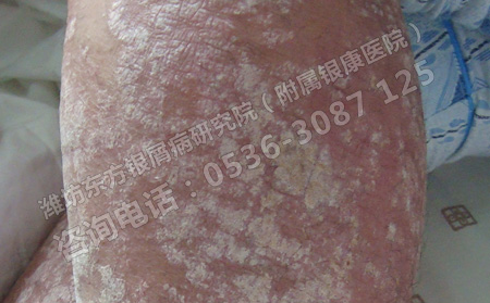 得了牛皮癣心理压力大怎么办