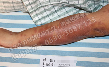 患上严重的银屑病类型怎么办