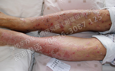 单纯西医可以治可以顽固性银屑病吗
