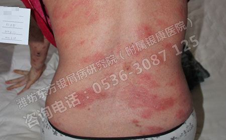 了解银屑病治疗误区临床治疗此病