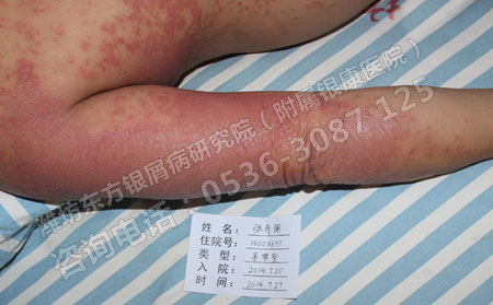 怎么有效的控制牛皮癣病情呢