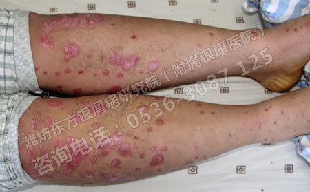 皮肤上就一点牛皮癣皮损可以被有效的治可以治治疗效果果可以吗
