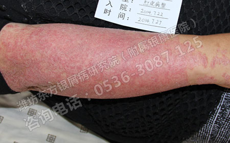 夏季银屑病预防保健的措施有哪些呢