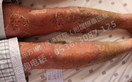 夏季银屑病患者吃点什么可以