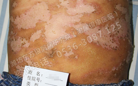 降低济南银屑病遗传的情况发生要怎么做