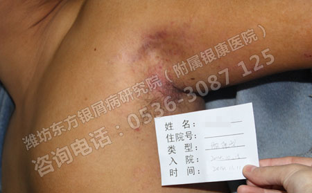 日常生活中牛皮癣患者要注意些什么