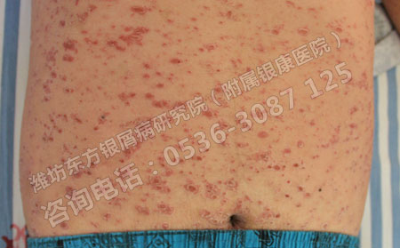 皮炎平可以治疗顽固性牛皮癣吗