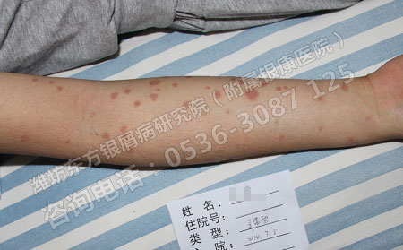 牛皮癣治疗多久能可以