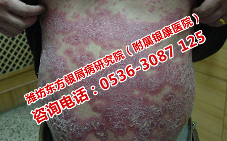 消银丸可以治疗牛皮癣吗