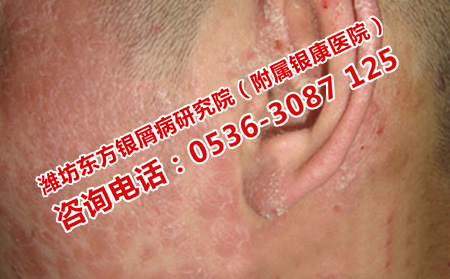 牛皮癣危害有哪些