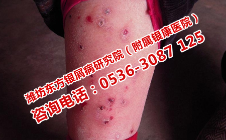 生活中牛皮癣怎么做好预防