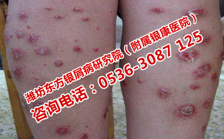牛皮癣能用西医治疗吗