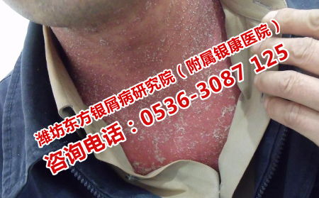 生活中牛皮癣的禁忌