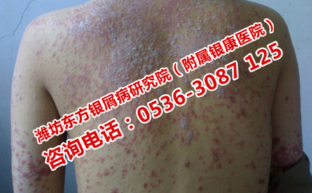 中医治疗多年牛皮癣