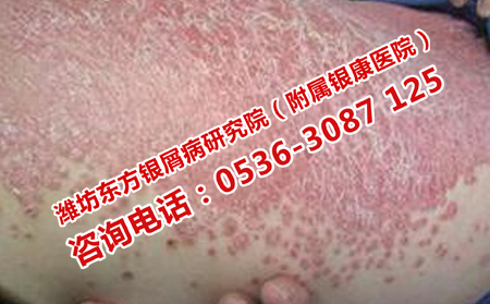 牛皮癣病情不治而愈