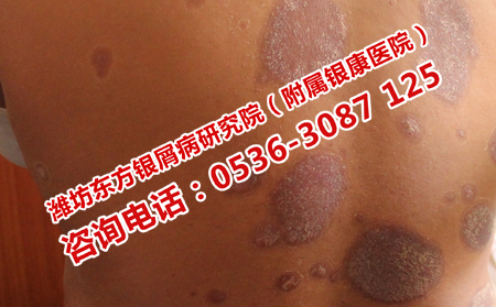 牛皮癣预防保健